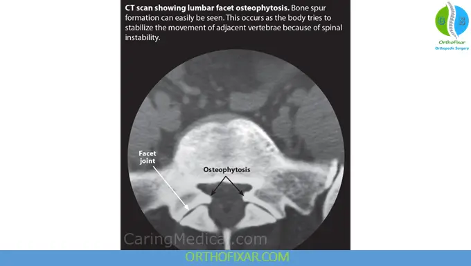 Degenerative Facet Arthrosis Imaging