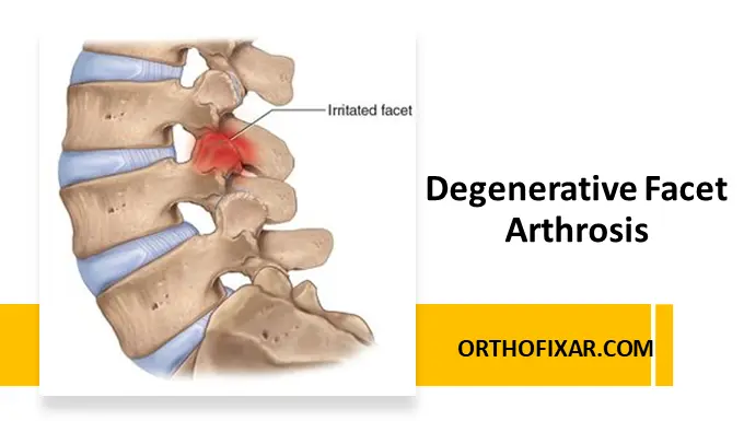 Degenerative Facet Arthrosis