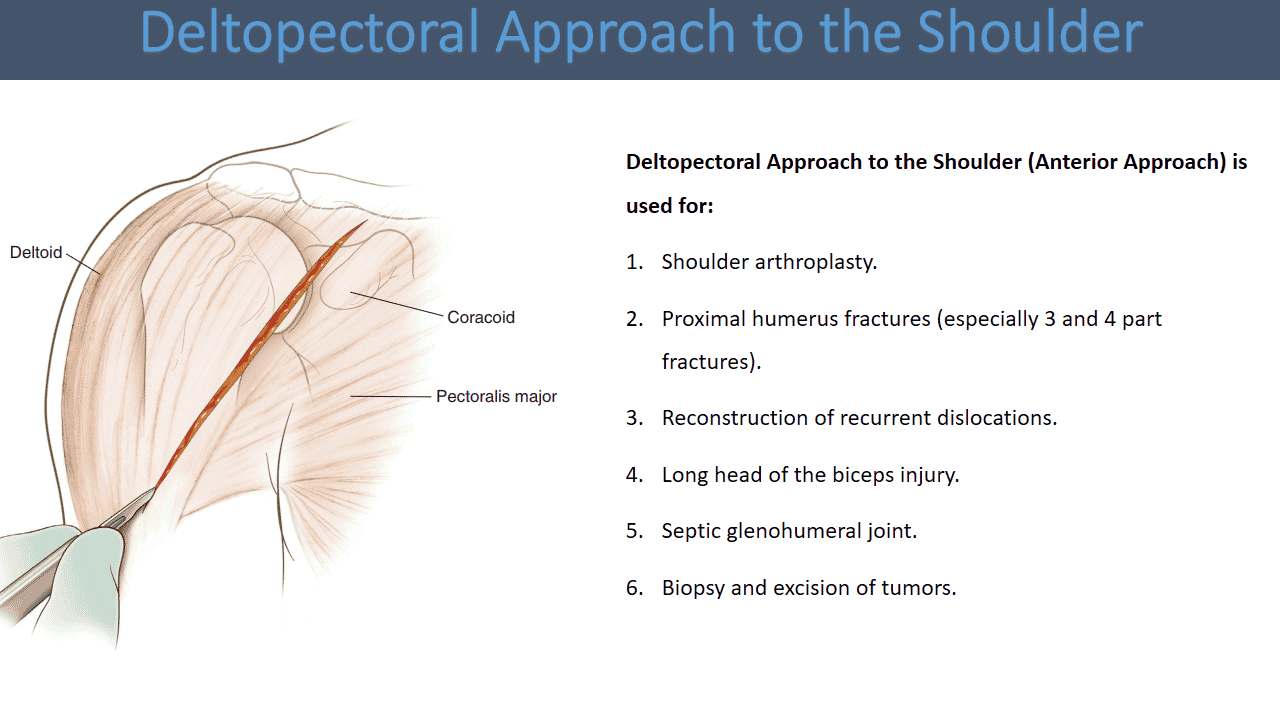  Deltopectoral Approach to the Shoulder 
