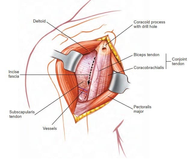Deltopectoral Approach to the Shoulder