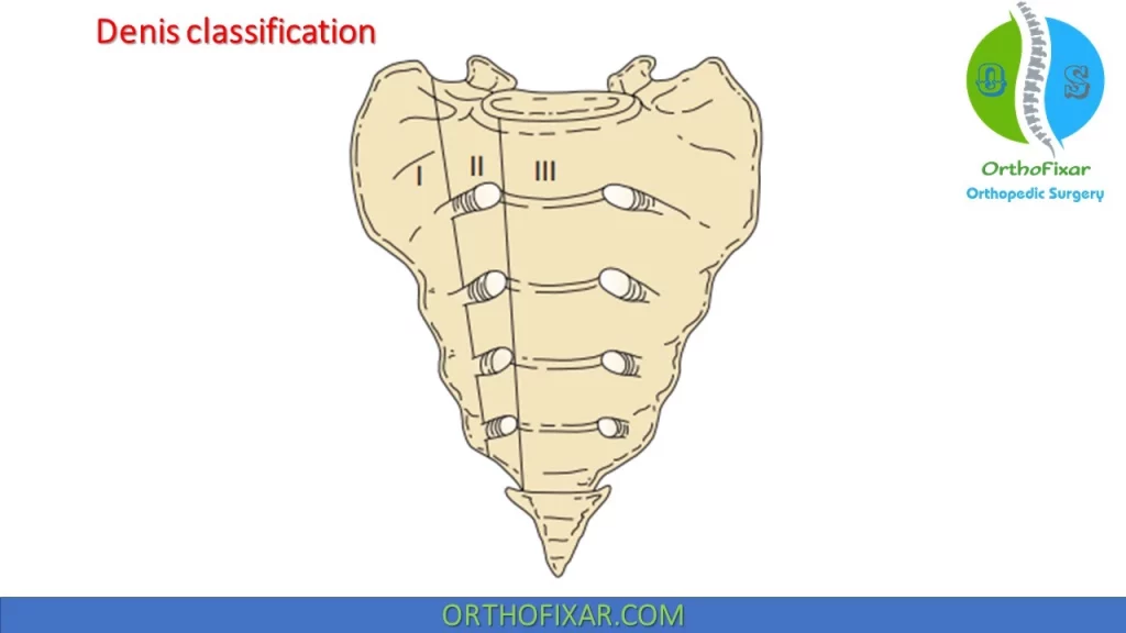 Denis classification of Sacral Fracture