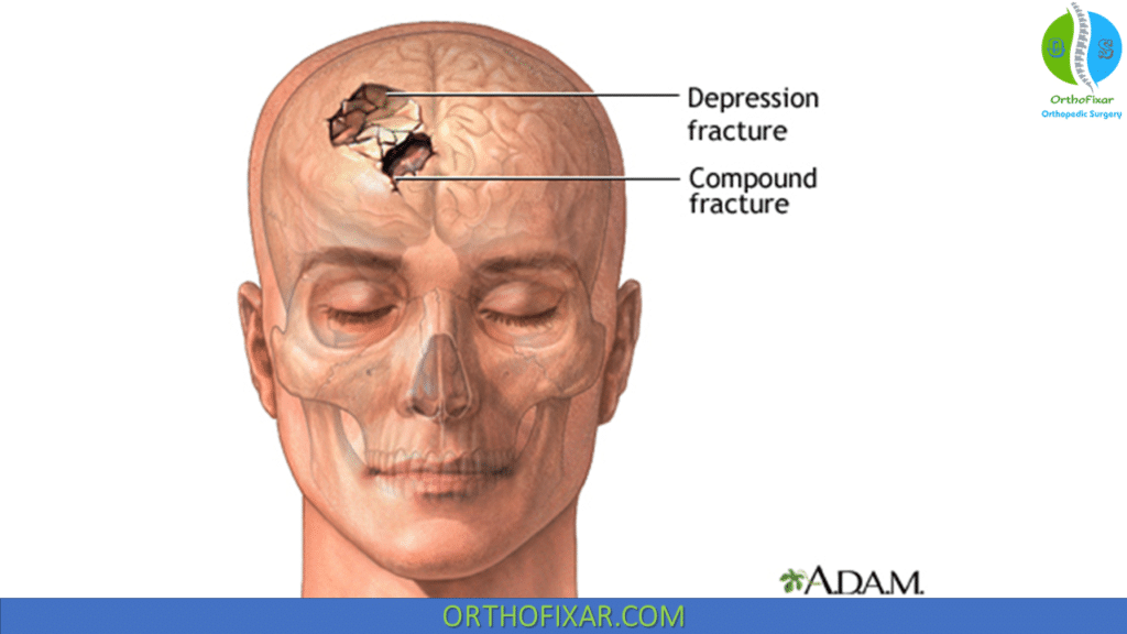Depressed skull fractures