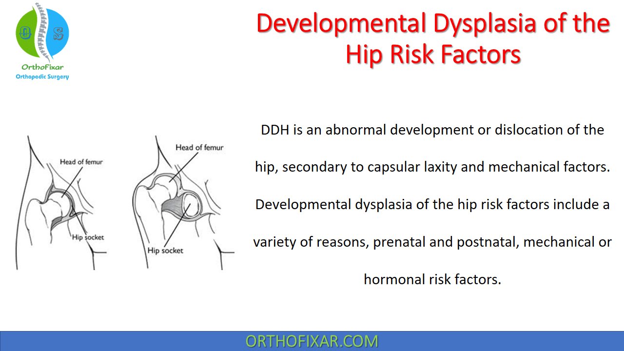 Developmental Dysplasia of the Hip Risk Factors
