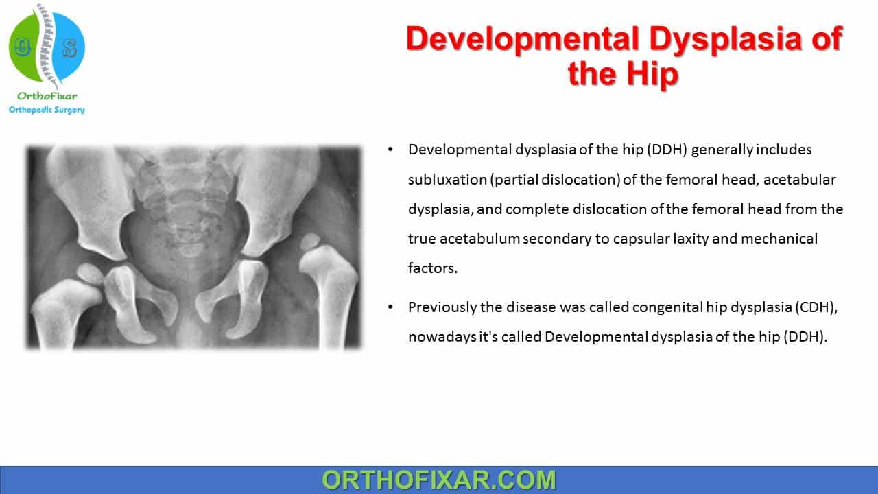  Developmental Dysplasia of the Hip 