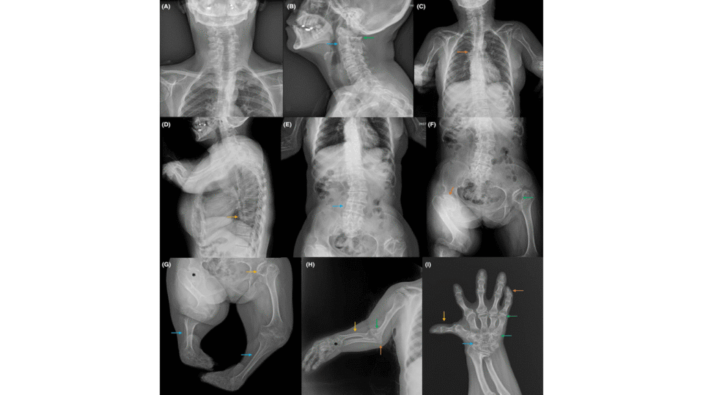 Diastrophic dysplasia xray