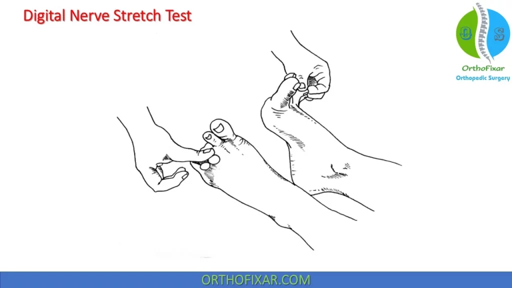 Digital Nerve Stretch Test