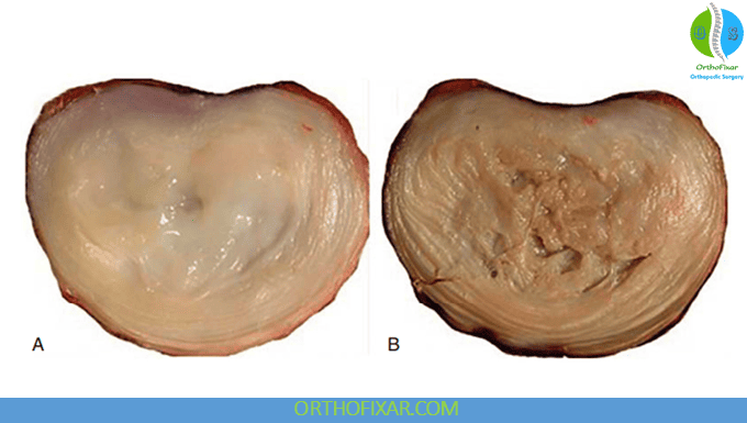 Disc Degeneration and Aging