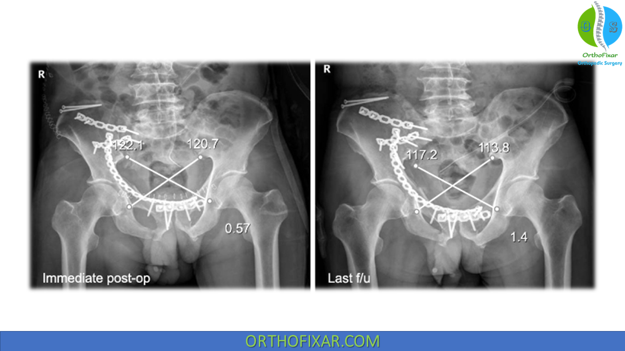 Sacroiliac Joint Dislocation Full Review OrthoFixar 2024