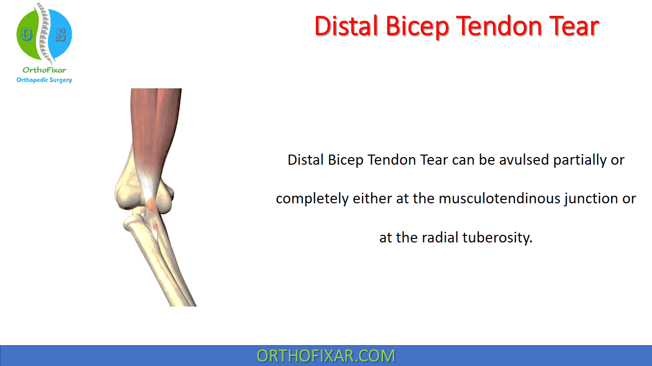 Distal Biceps Tendon Tear
