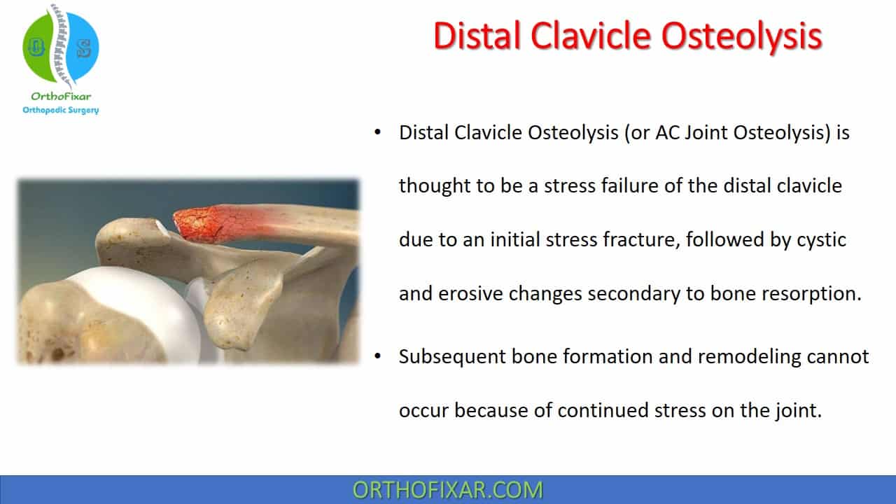  Distal Clavicle Osteolysis 