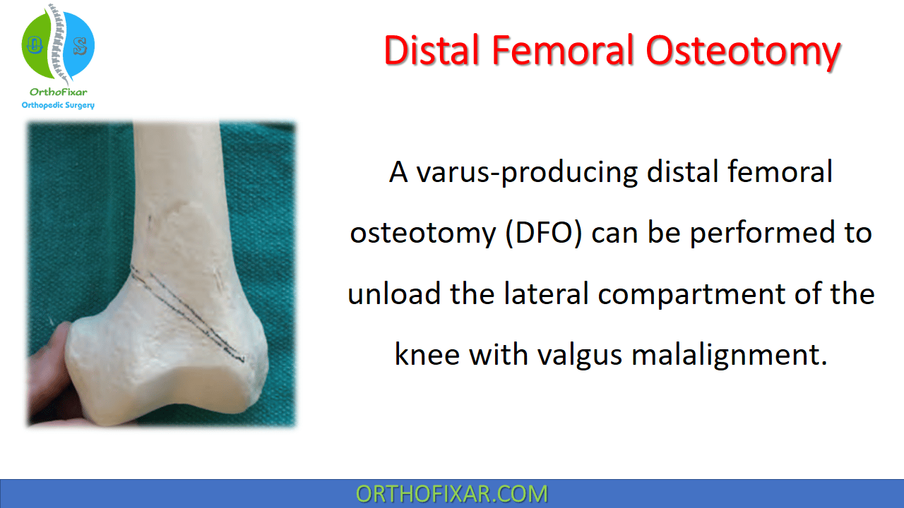  Distal Femoral Osteotomy 