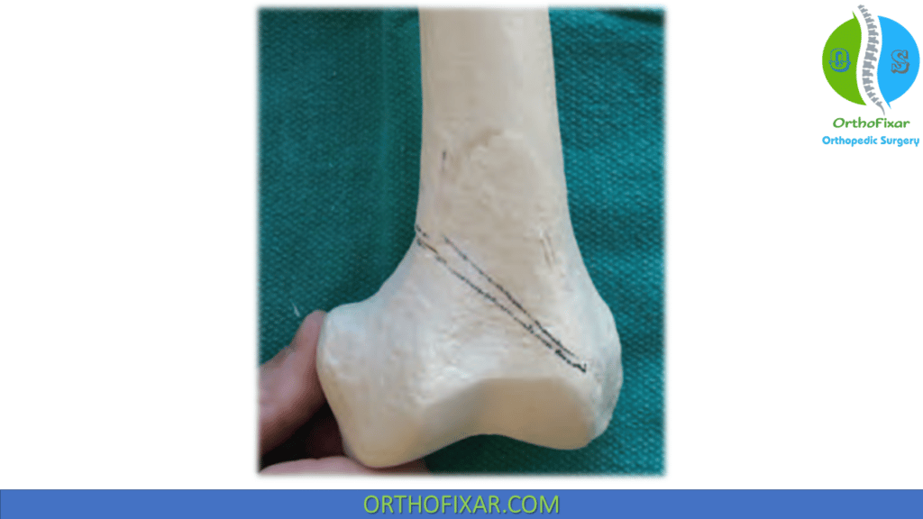 Distal Femoral Osteotomy