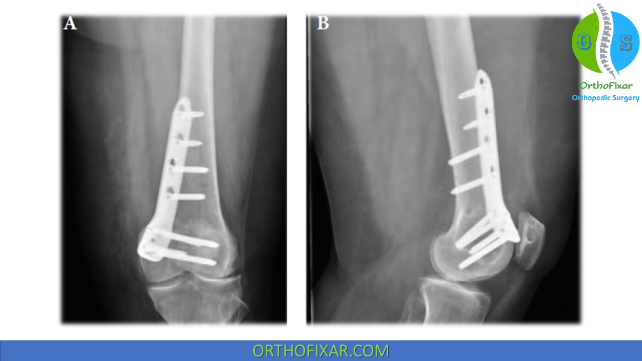 Distal Femoral Osteotomy