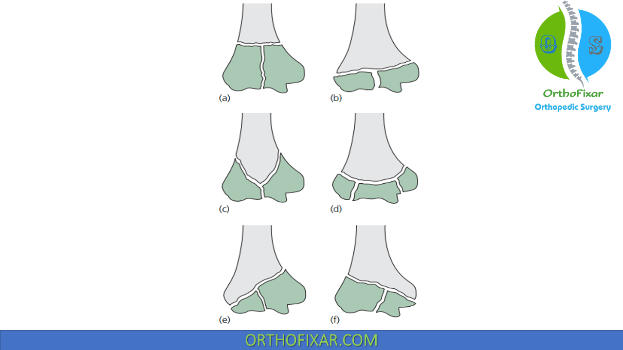 Distal Humerus Fracture Orthofixar