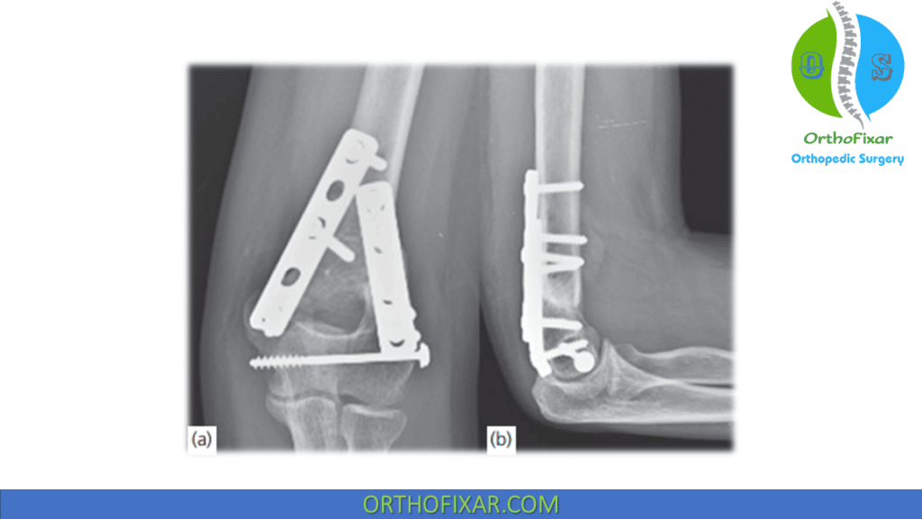 Distal Humerus Fracture tratment
