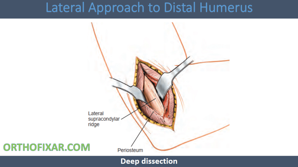 Distal Humerus Lateral Approach