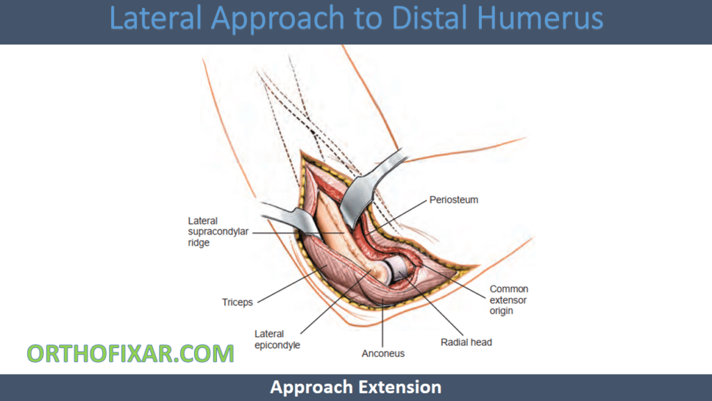 Distal Humerus Lateral Approach