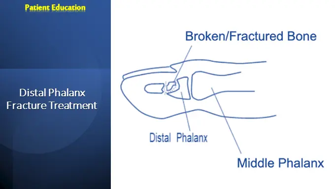 Distal Phalanx Fracture Treatment
