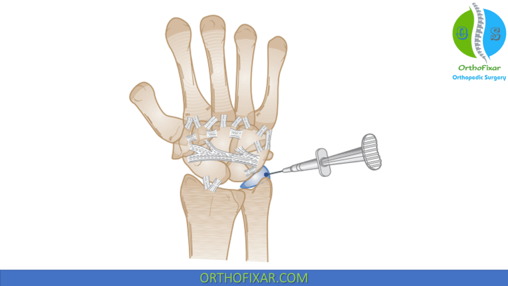 Wrist Injection Technique | OrthoFixar 2024