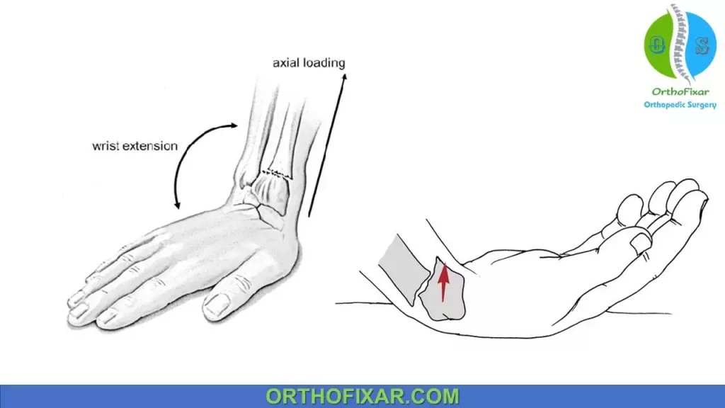 Distal Radius fracture injury mechanism