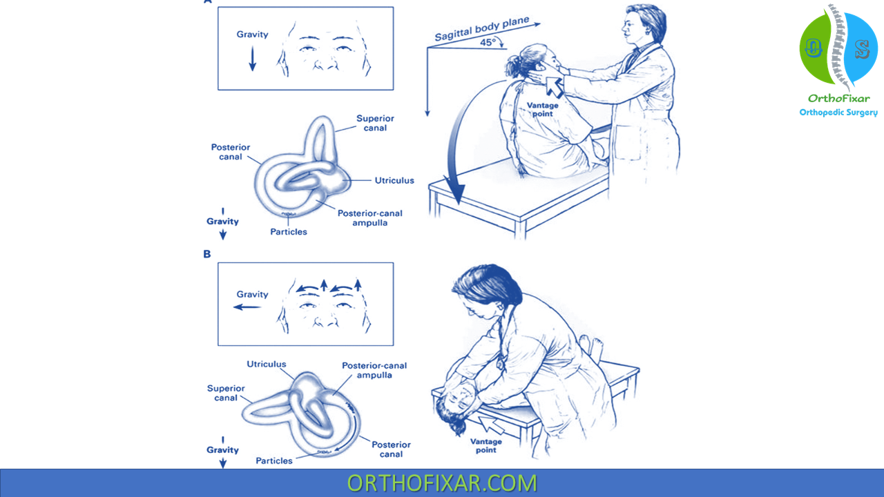 dix-hallpike-maneuver-gold-standard-test-for-bppv-vertigo-diagnosis
