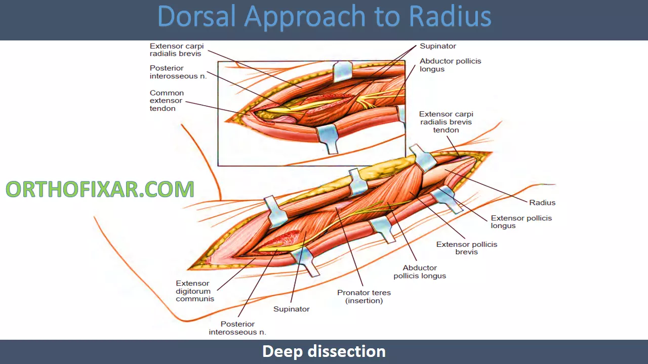 Dorsal Approach to Radius deep incesion (1)