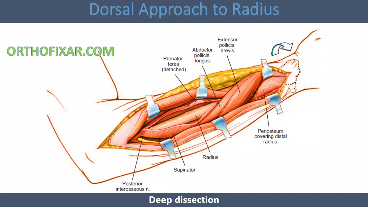 Dorsal Approach to Radius deep incesion (2)