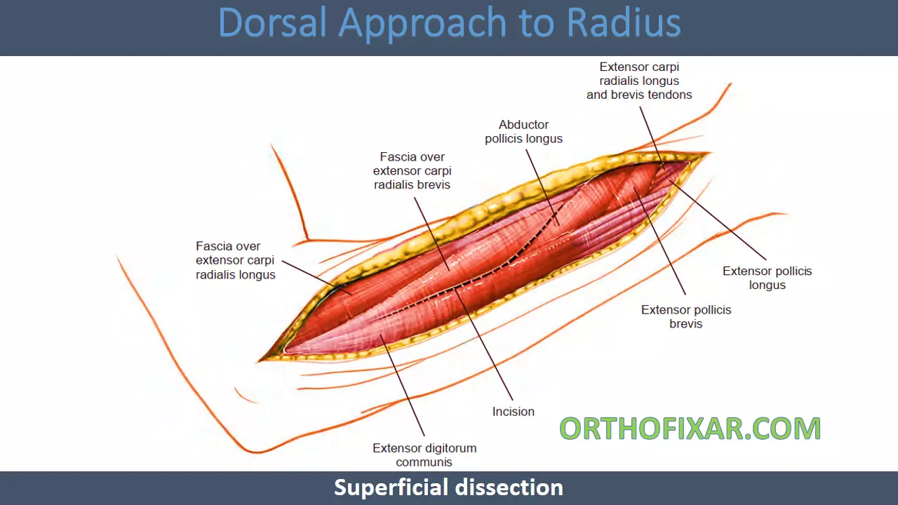 Dorsal Approach to Radius superfecial incision (1)
