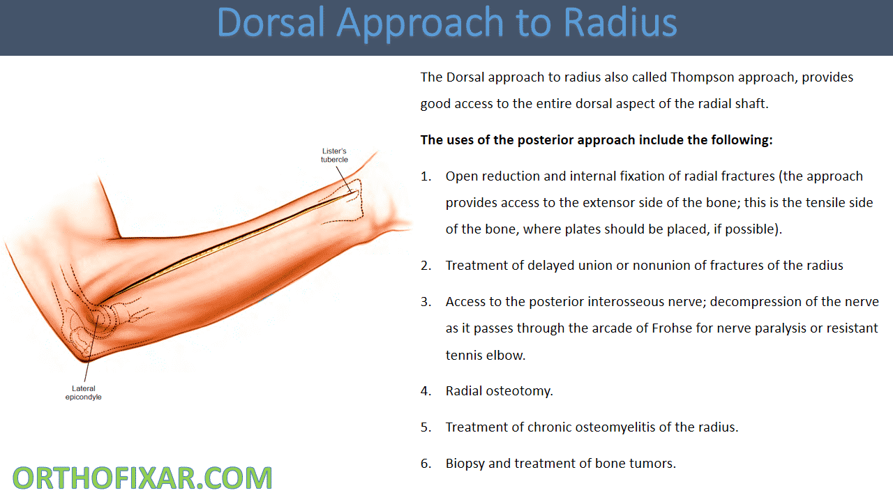  Dorsal Approach to Radius 