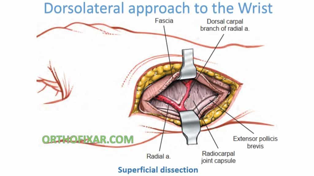Dorsolateral approach to the Wrist