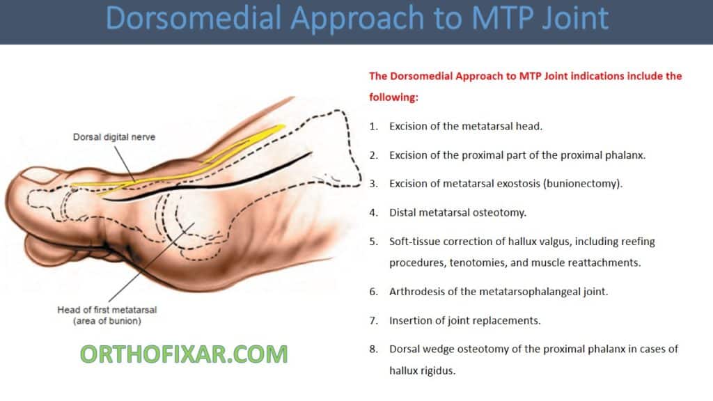 Dorsomedial Approach To MTP Joint: Surgical Technique, Indications, And ...