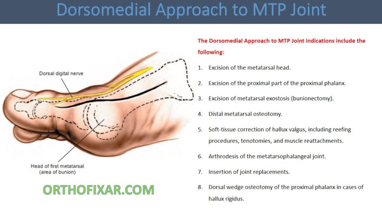 Dorsomedial Approach to MTP Joint