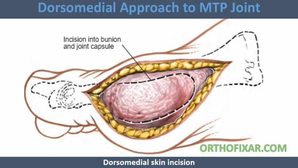 Dorsomedial Approach to MTP Joint
