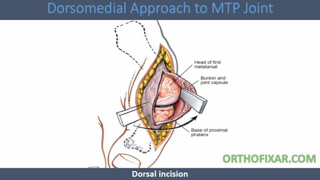 Dorsomedial Approach to MTP Joint