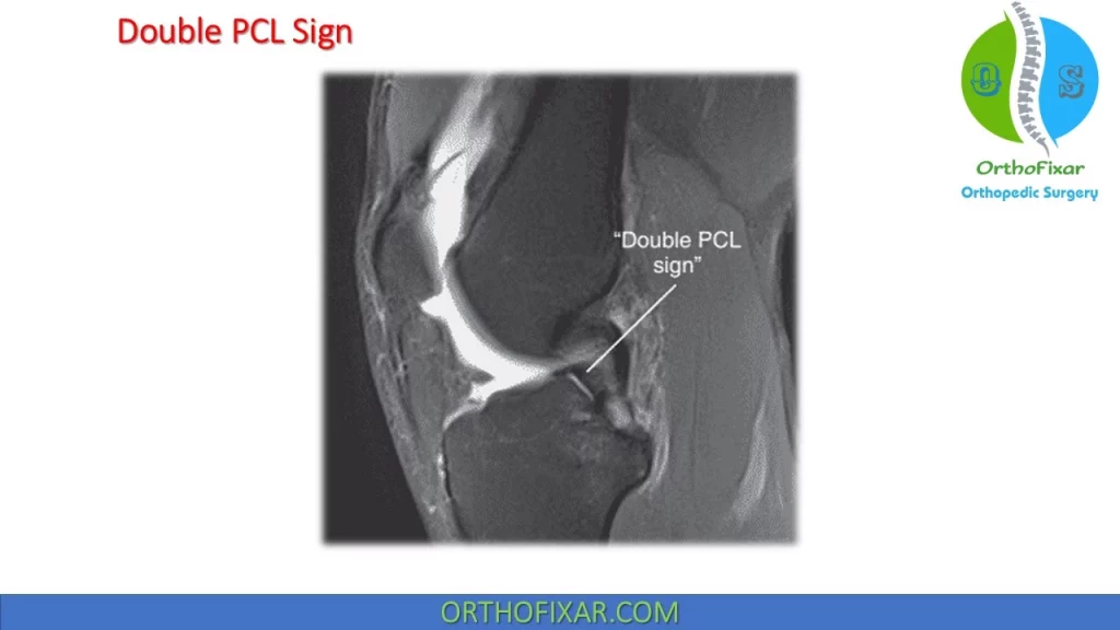Double PCL sign knee