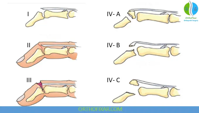Doyle's Classification of Mallet Finger Injuries