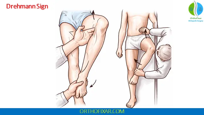 Drehmann Sign hip