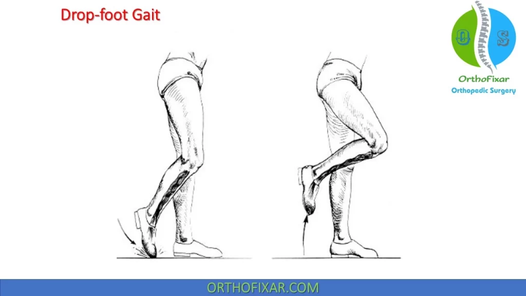 Drop-foot gait