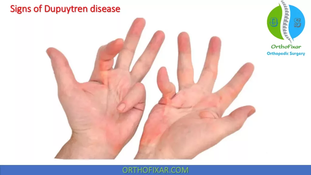 Dupuytren disease symptoms