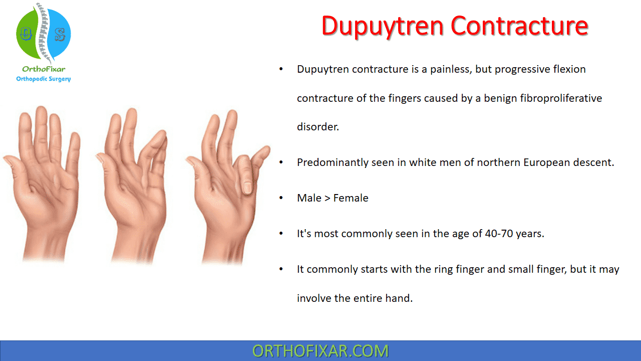 Dupuytren Contracture Easy Explaned Orthofixar 2023