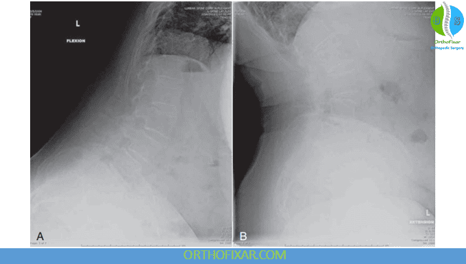 Lumbar Spine X-Ray Views 4 Dynamic lumbar spine X-rays (flexion and extension lateral views)