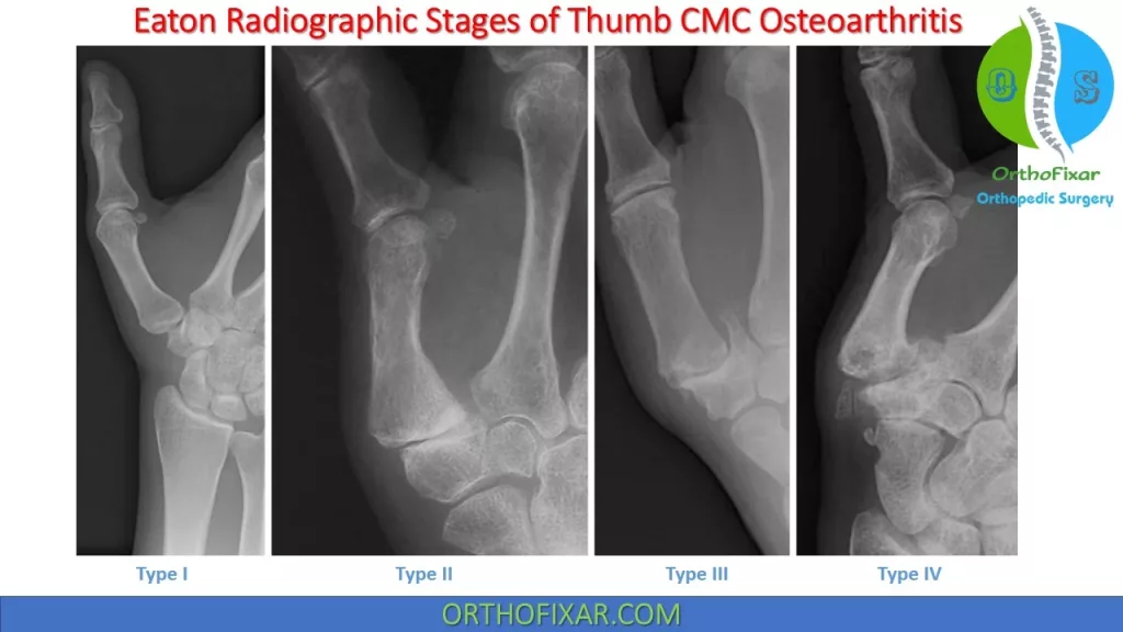 Eaton Radiographic Stages of thumb CMC osteoarthritis 
