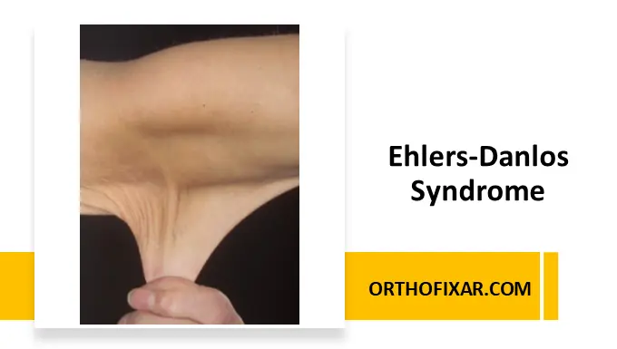 Ehlers-Danlos Syndrome