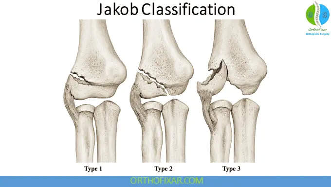 Pediatric Elbow - Lateral Condyle Fractures 9 Elbow Lateral Condyle Fractures Jakob Classification