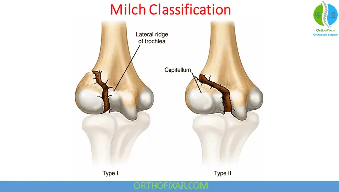 Pediatric Elbow - Lateral Condyle Fractures 8 Elbow Lateral Condyle Fractures Milch Classification