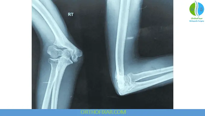 Pediatric Elbow - Lateral Condyle Fractures 11 Elbow Lateral Condyle Fractures Nonunion