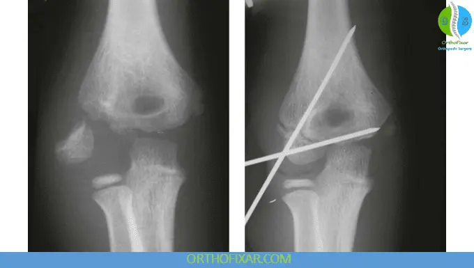 Pediatric Elbow - Lateral Condyle Fractures 10 Elbow Lateral Condyle Fractures fixation