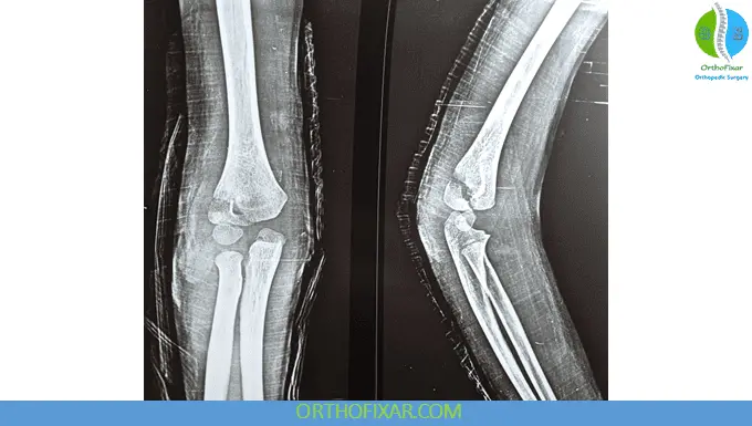 Pediatric Elbow - Lateral Condyle Fractures 7 Elbow Lateral Condyle Fractures xray