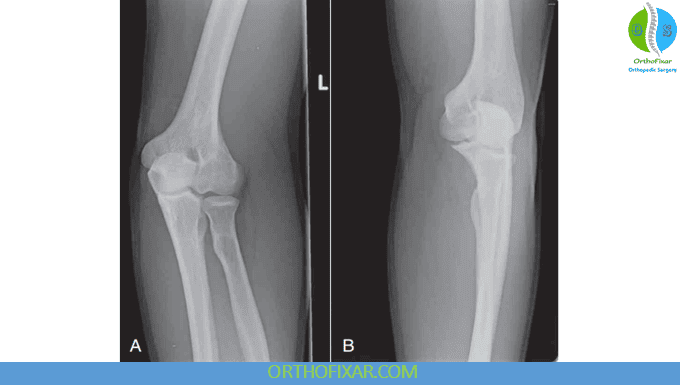 Elbow X-ray Views 4 Elbow Oblique Views