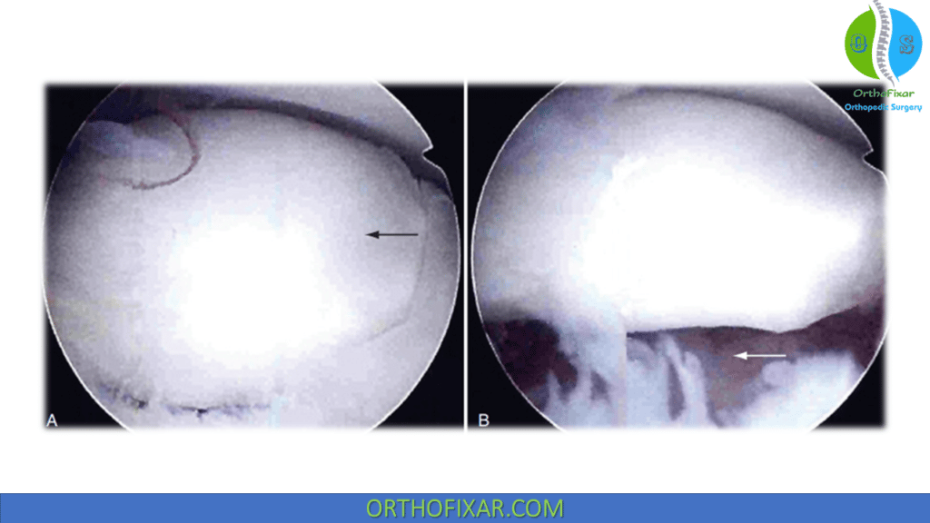 Elbow Osteochondritis Dissecans arthroscopy